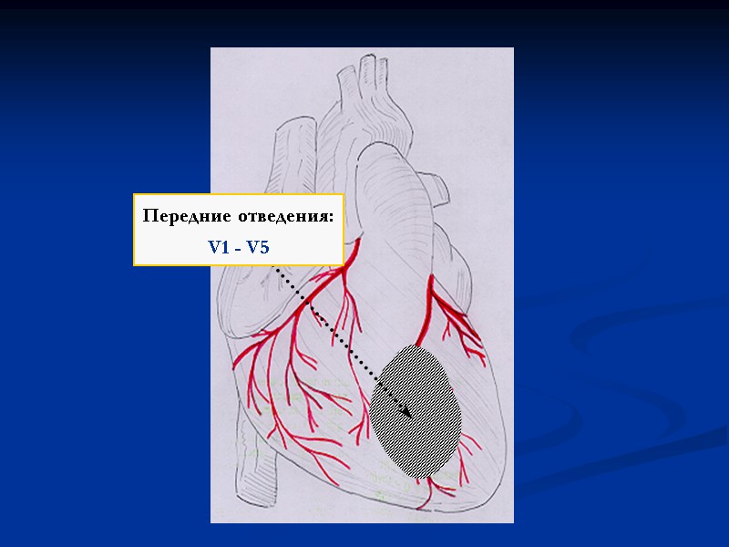 Передние отведения: V1 - V5